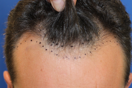 Follicular Unit Extraction Before & After Patient #5053