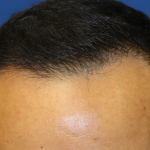 Follicular Unit Extraction Before & After Patient #5023