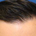 Follicular Unit Extraction Before & After Patient #5039