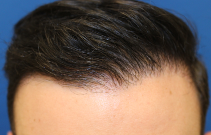 Follicular Unit Extraction Before & After Patient #5039