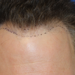 Follicular Unit Extraction Before & After Patient #5046