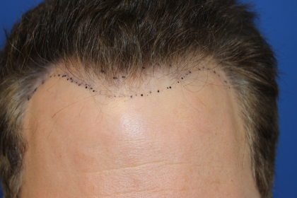 Follicular Unit Extraction Before & After Patient #5046