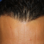 Follicular Unit Extraction Before & After Patient #5053