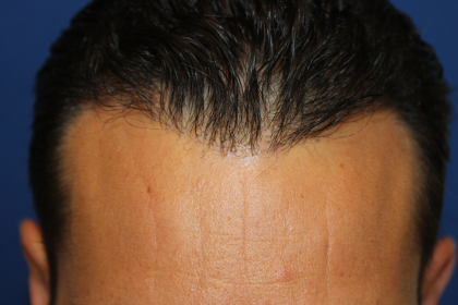 Follicular Unit Extraction Before & After Patient #5053