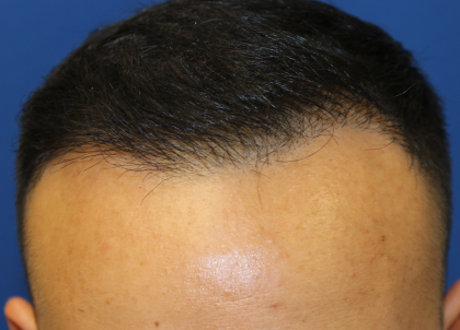 Follicular Unit Extraction Before & After Patient #5023