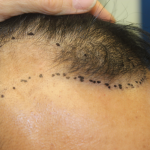 Follicular Unit Extraction Before & After Patient #5023