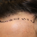 Follicular Unit Extraction Before & After Patient #5039