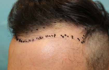 Follicular Unit Extraction Before & After Patient #5039