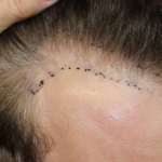 Follicular Unit Extraction Before & After Patient #5046