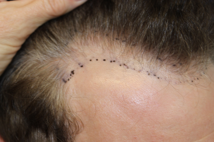 Follicular Unit Extraction Before & After Patient #5046