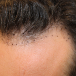 Follicular Unit Extraction Before & After Patient #5053