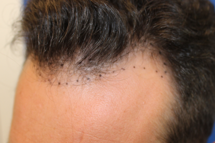 Follicular Unit Extraction Before & After Patient #5053