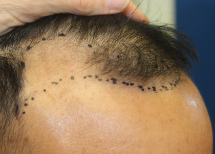 Follicular Unit Extraction Before & After Patient #5023