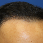 Follicular Unit Extraction Before & After Patient #5023