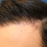 Follicular Unit Extraction Before & After Patient #5039