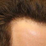 Follicular Unit Extraction Before & After Patient #5046