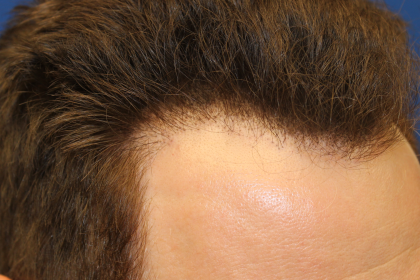 Follicular Unit Extraction Before & After Patient #5046