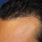 Follicular Unit Extraction Before & After Patient #5053