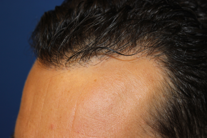 Follicular Unit Extraction Before & After Patient #5053