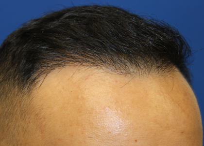 Follicular Unit Extraction Before & After Patient #5023