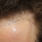 Follicular Unit Extraction Before & After Patient #5046