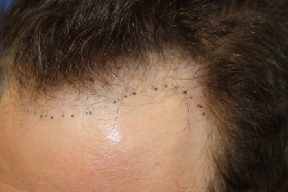 Follicular Unit Extraction Before & After Patient #5046