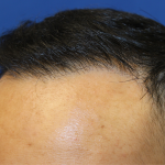 Follicular Unit Extraction Before & After Patient #5023