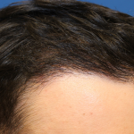 Follicular Unit Extraction Before & After Patient #5039