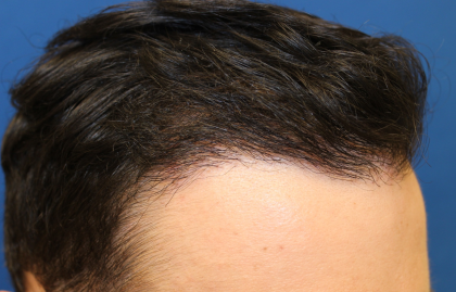 Follicular Unit Extraction Before & After Patient #5039