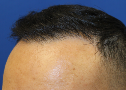 Follicular Unit Extraction Before & After Patient #5023