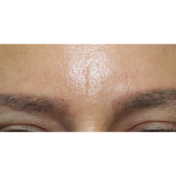 Eyebrows Before & After Patient #5084