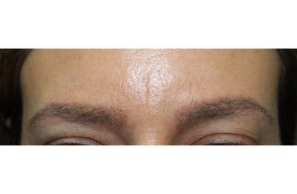 Eyebrows Before & After Patient #5084
