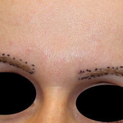 Eyebrows Before & After Patient #5085