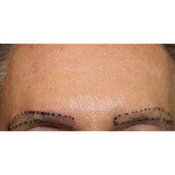 Eyebrows Before & After Patient #5083