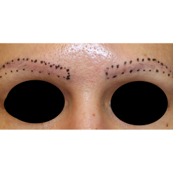 Eyebrows Before & After Patient #5086
