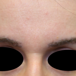 Eyebrows Before & After Patient #5085