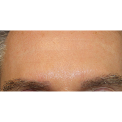 Eyebrows Before & After Patient #5083