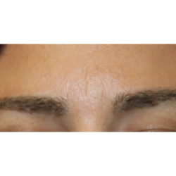 Eyebrows Before & After Patient #5084
