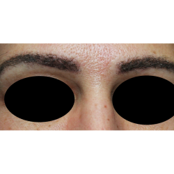 Eyebrows Before & After Patient #5086