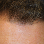 Follicular Unit Extraction Before & After Patient #5106