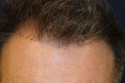 Follicular Unit Extraction Before & After Patient #5106