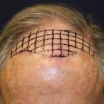 Follicular Unit Extraction Before & After Patient #5099