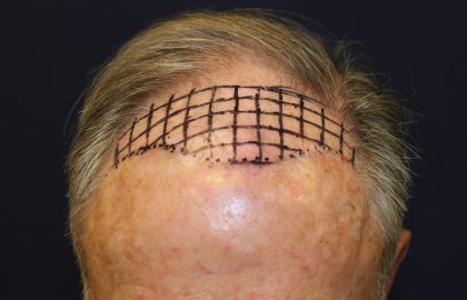 Follicular Unit Extraction Before & After Patient #5099