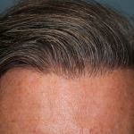 Follicular Unit Extraction Before & After Patient #5106