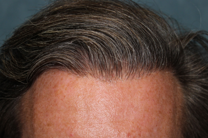 Follicular Unit Extraction Before & After Patient #5106