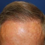 Follicular Unit Extraction Before & After Patient #5099
