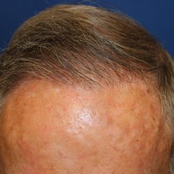 Follicular Unit Extraction Before & After Patient #5099