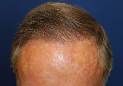 Follicular Unit Extraction Before & After Patient #5099