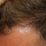 Follicular Unit Extraction Before & After Patient #5106