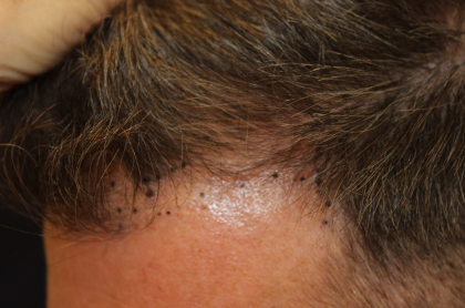 Follicular Unit Extraction Before & After Patient #5106